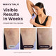 Woman using Wavytalk IPL device with before and after results on skin.
